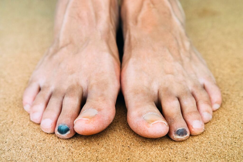 Ongle noir en course à pied : que faire et comment l’éviter ?