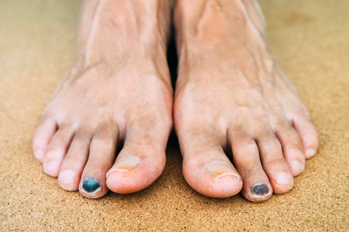 Ongle noir en course à pied : que faire et comment l’éviter ?